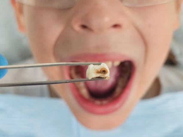Best Emergency Dental Extractions in Rden, WA